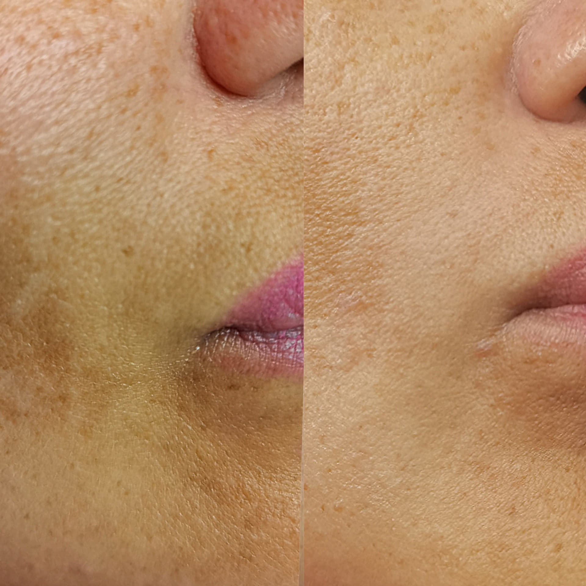 Fotorejuvenacija lica